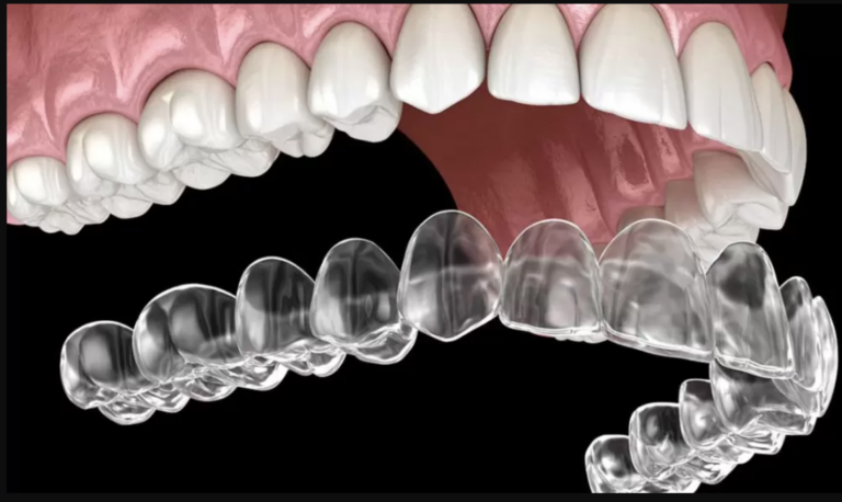 Invisalign ile Telsiz Ortodonti: Estetik ve Konforlu Gülüşler