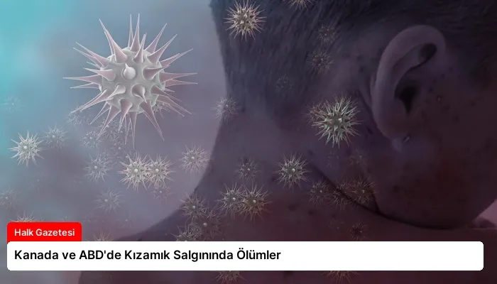 Kanada ve ABD’de Kızamık Salgınında Ölümler