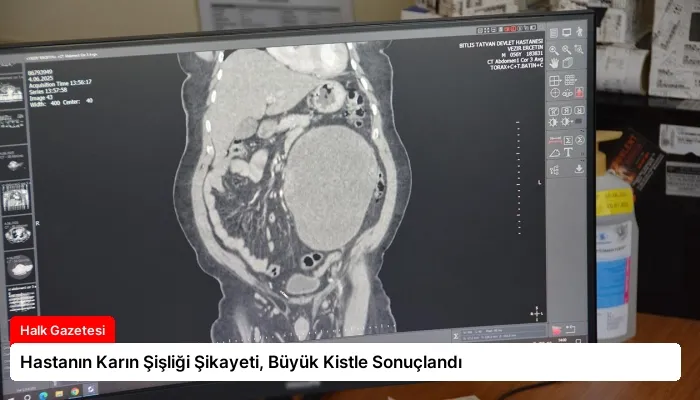 Hastanın Karın Şişliği Şikayeti, Büyük Kistle Sonuçlandı