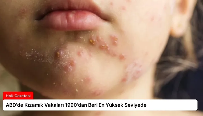 ABD’de Kızamık Vakaları 1990’dan Beri En Yüksek Seviyede