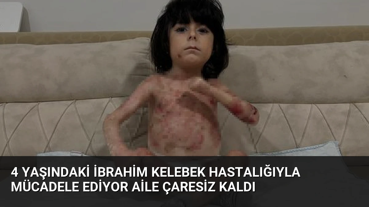 4 Yaşındaki İbrahim Kelebek Hastalığıyla Mücadele Ediyor Aile Çaresiz Kaldı