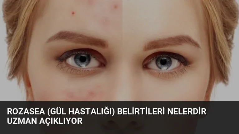 Rozasea (Gül Hastalığı) Belirtileri Nelerdir Uzman Açıklıyor