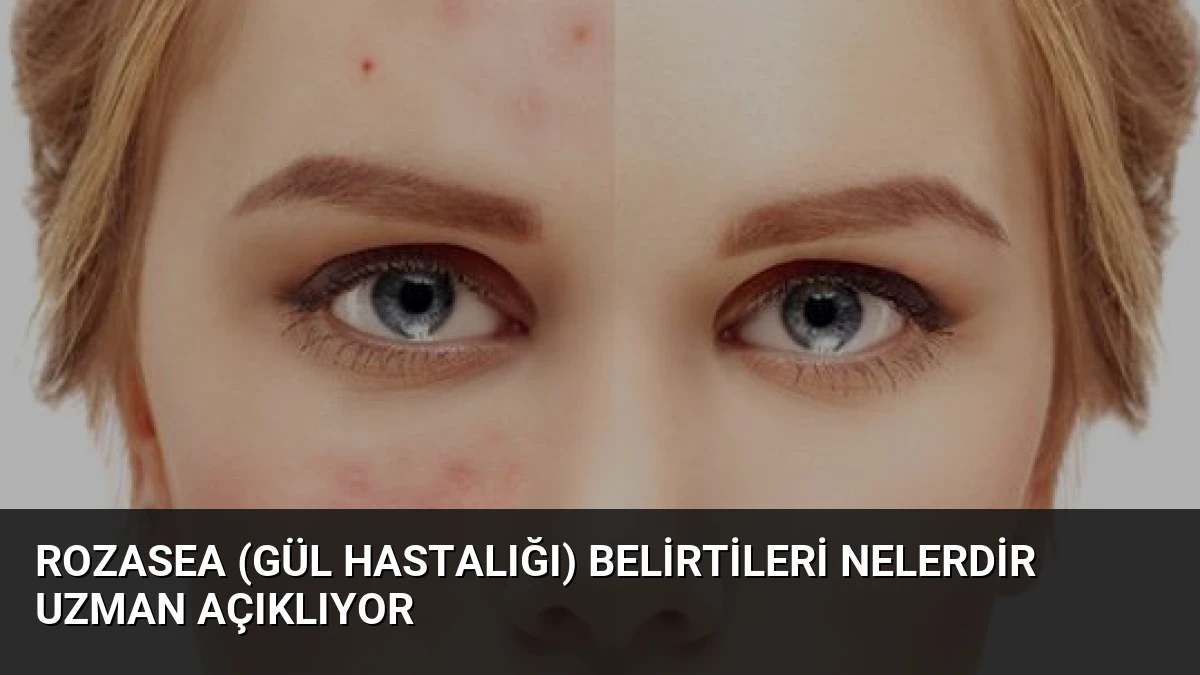 Rozasea (Gül Hastalığı) Belirtileri Nelerdir Uzman Açıklıyor