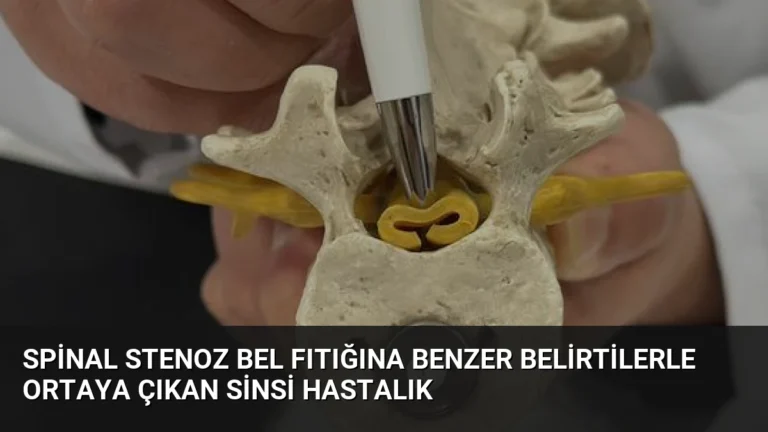 Spinal Stenoz Bel Fıtığına Benzer Belirtilerle Ortaya Çıkan Sinsi Hastalık