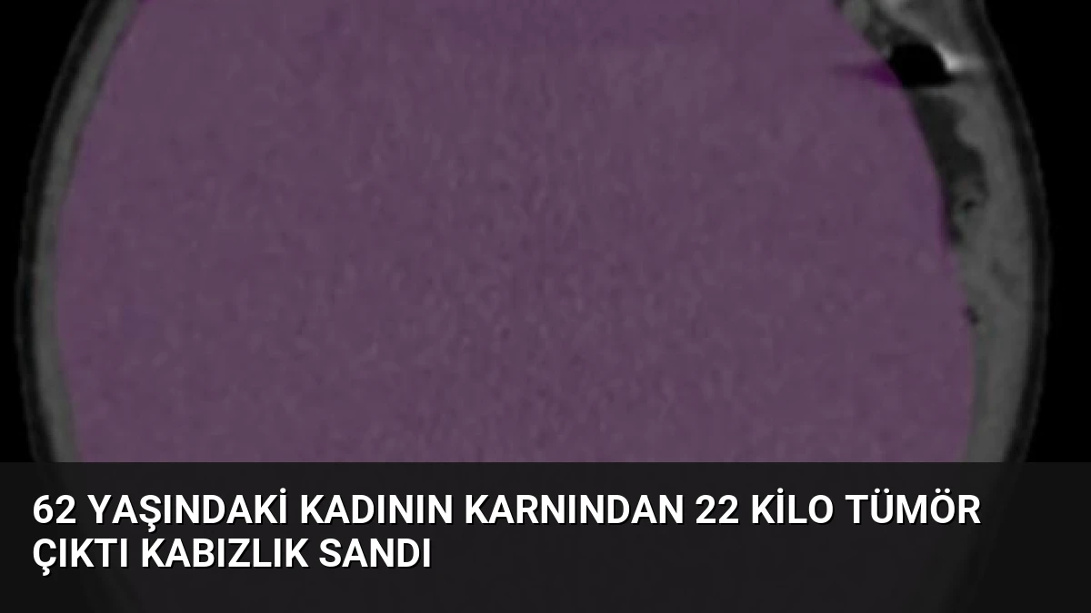 62 Yaşındaki Kadının Karnından 22 Kilo Tümör Çıktı Kabızlık Sandı