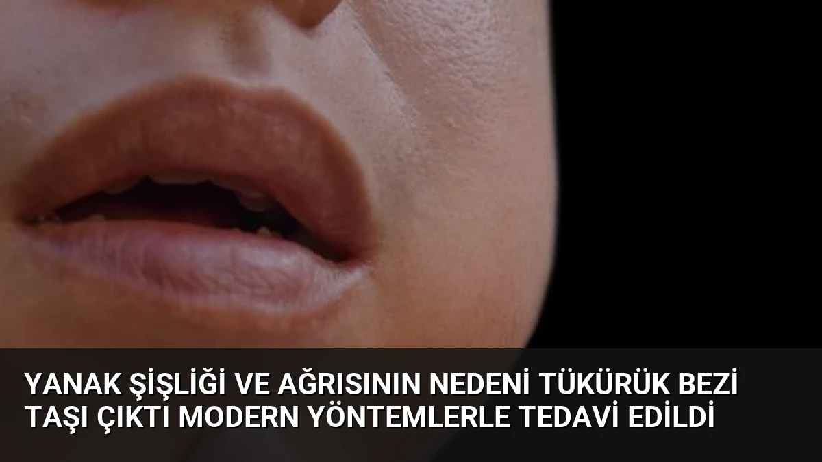 Yanak Şişliği ve Ağrısının Nedeni Tükürük Bezi Taşı Çıktı Modern Yöntemlerle Tedavi Edildi